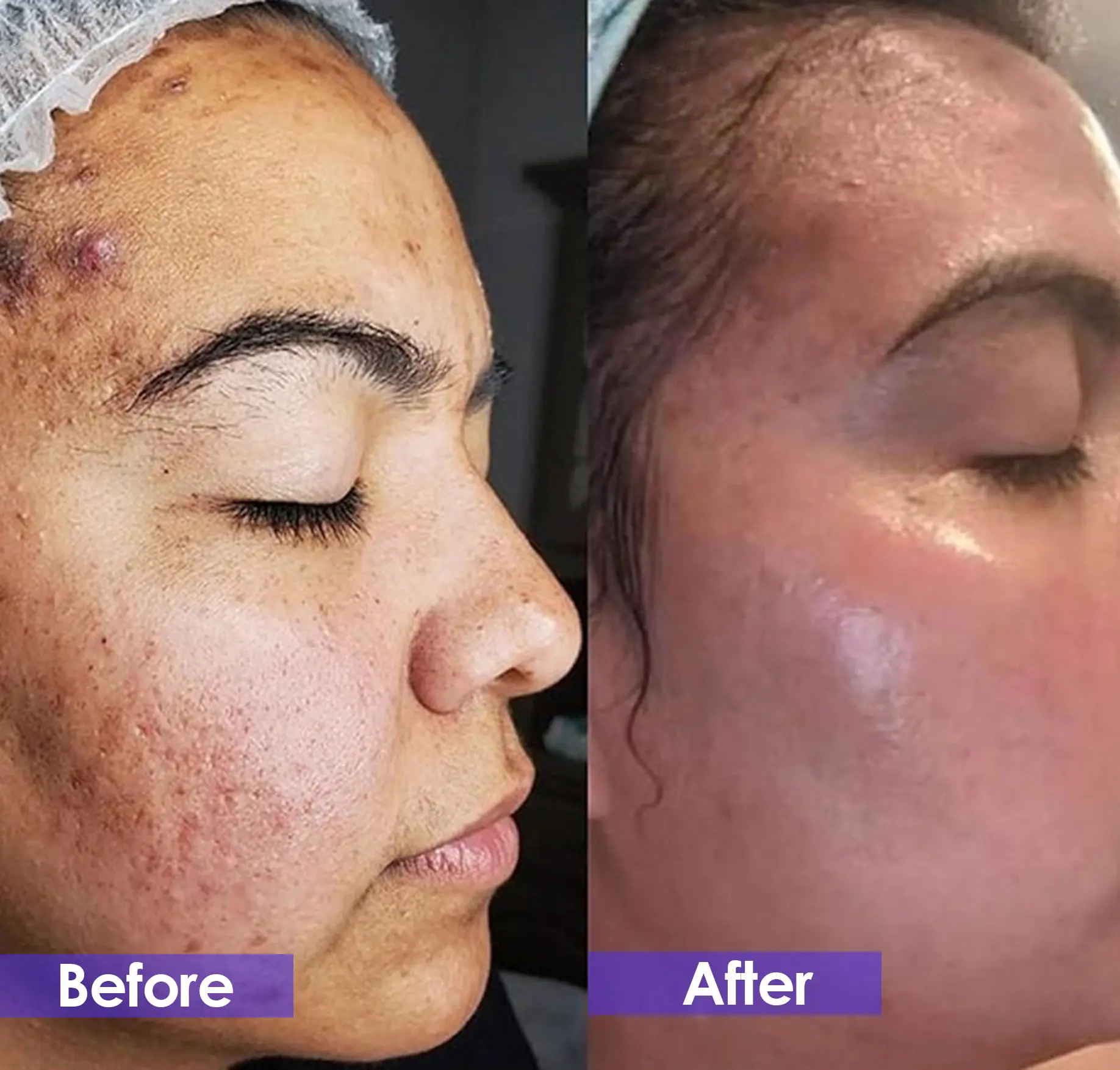 Morpheus 8 before and after treatment - facial acne treatment comparison
